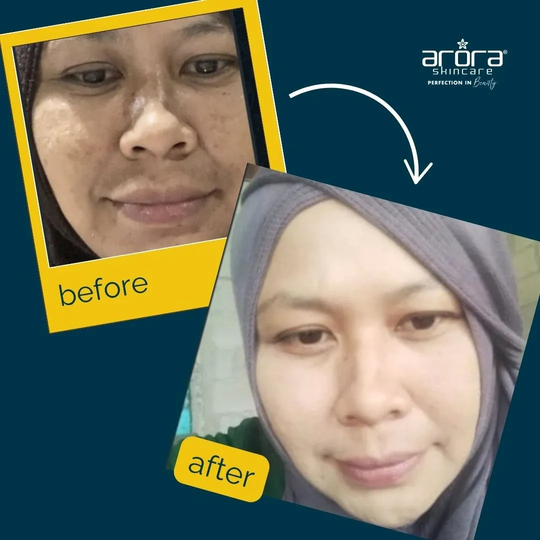 Kulit kusam 2