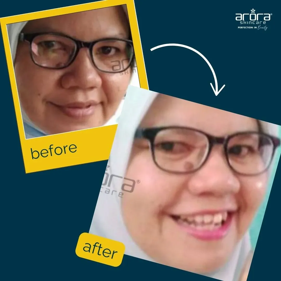 Kulit kusam 8