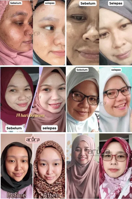 Transformasi pengguna Arora Skincare