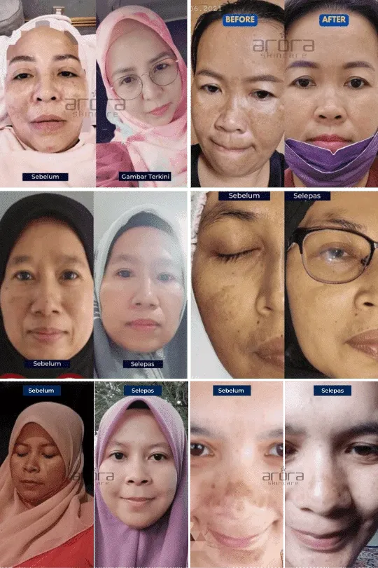 Transformasi pengguna Arora Skincare