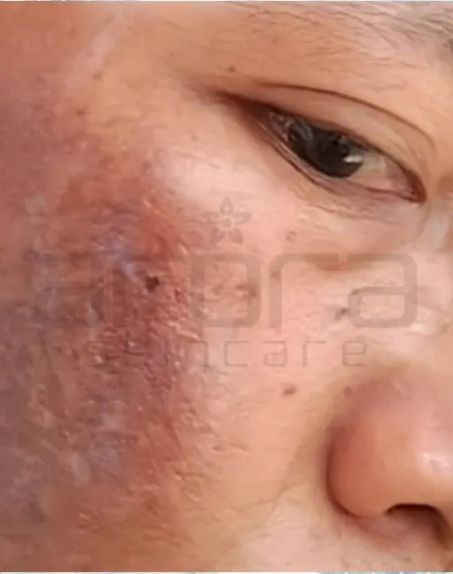 Kulit Rosak