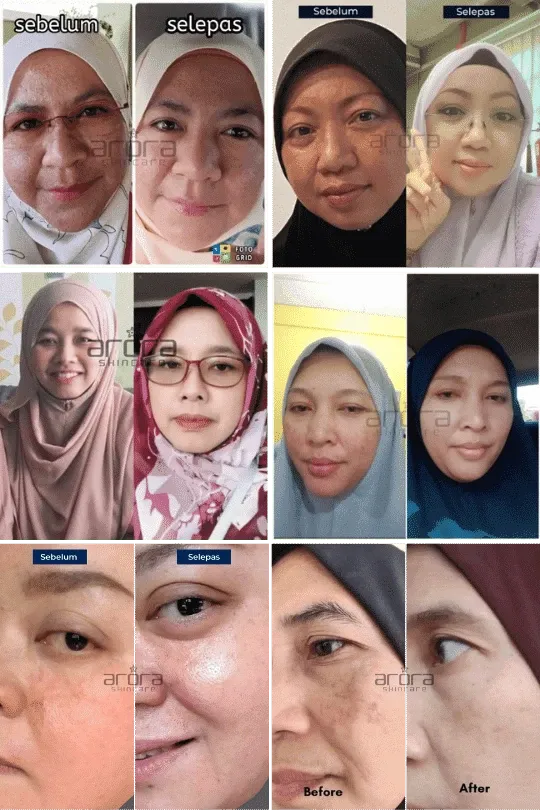 Transformasi pengguna Arora Skincare