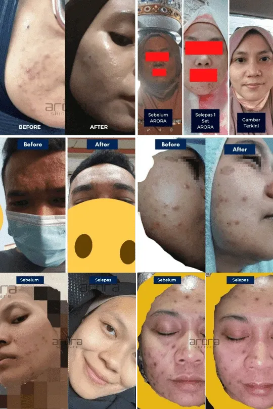 Transformasi pengguna Arora Skincare