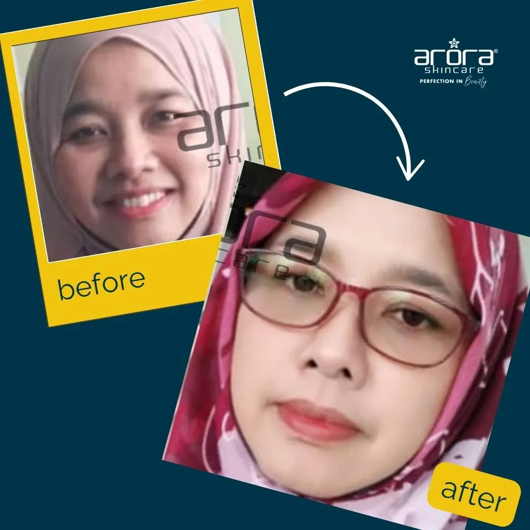 Kulit kusam 6