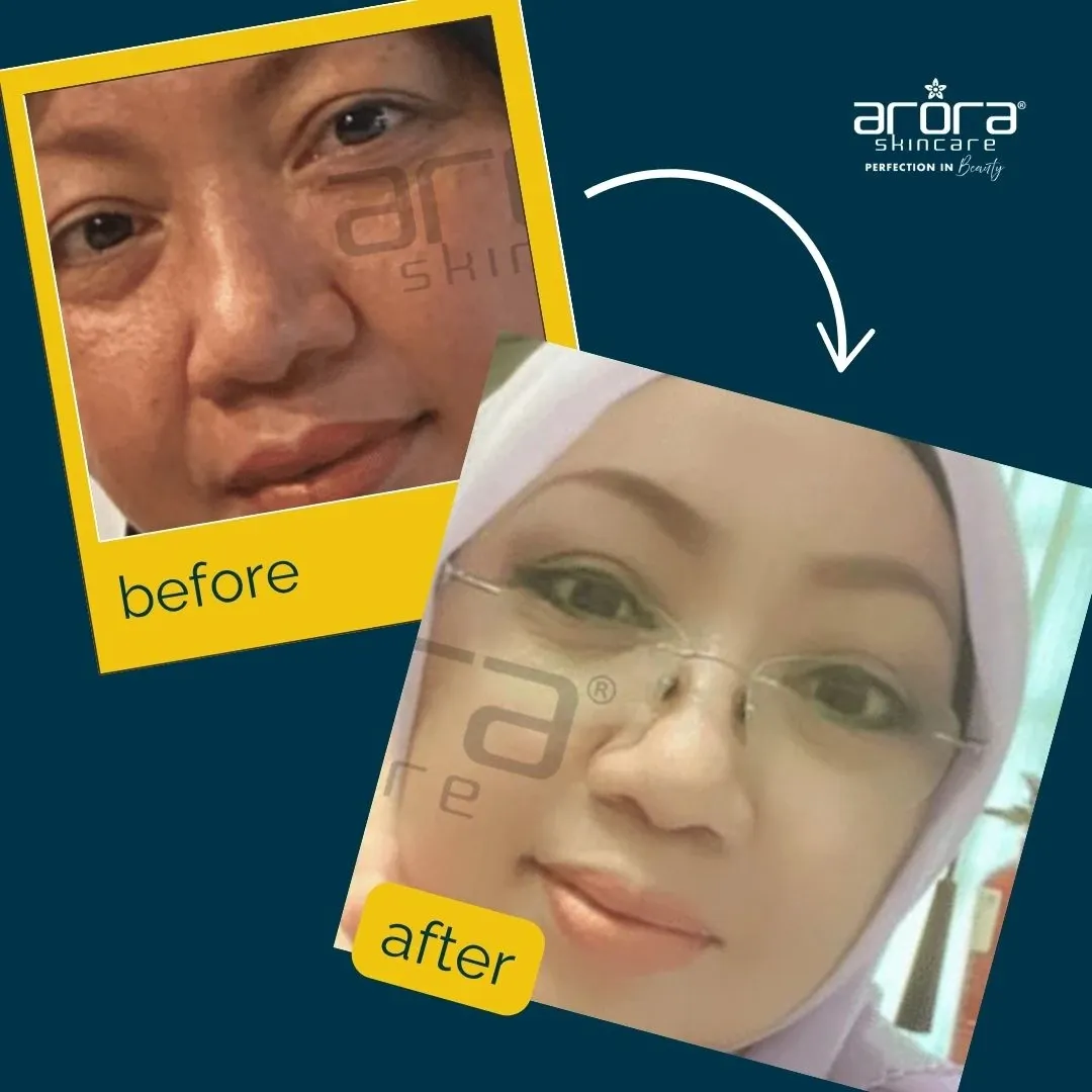 Kulit kusam 1